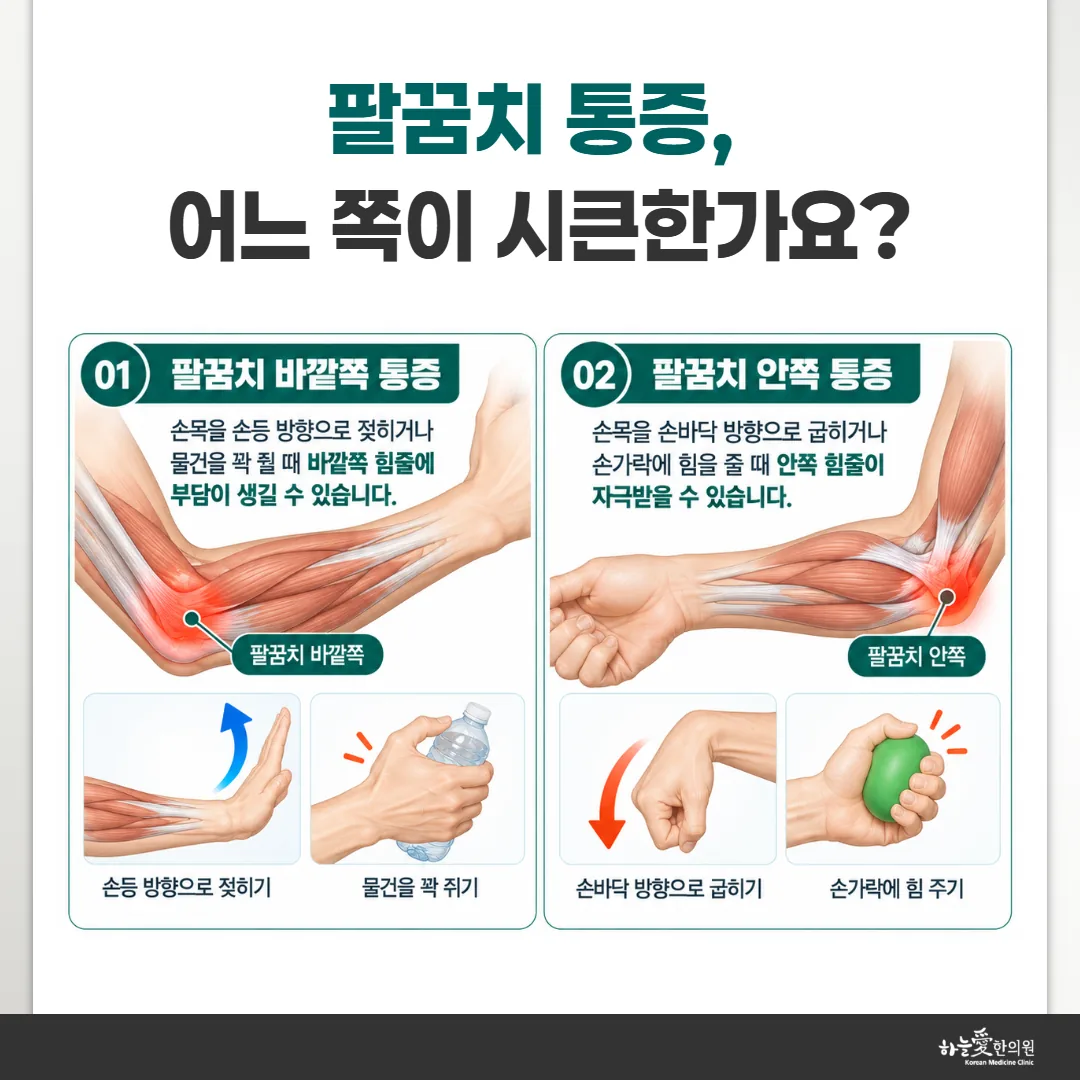 팔꿈치 바깥쪽과 안쪽 통증 자리와 이어지는 손목 동작 도식
