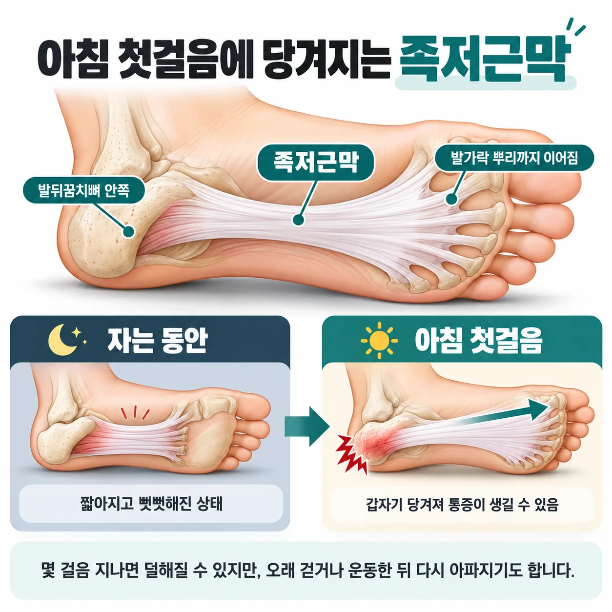 아침 첫걸음에 당겨지는 족저근막의 위치를 보여 주는 발바닥 개념도